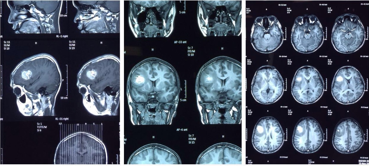 Kanker Otak – Neurosurgery